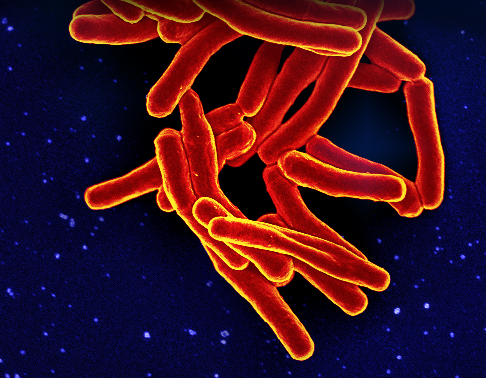 :SAIRAUDET: Vihtiläisestä päiväkodista on löytynyt tuberkuloosia